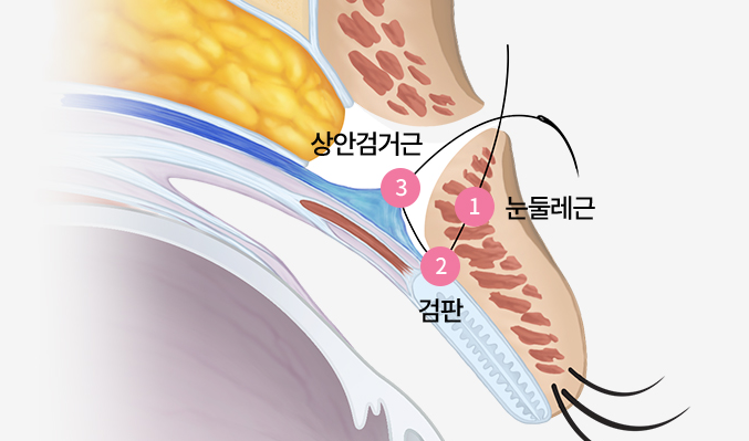 절개눈 재수술, 소세지눈 고민부터 눈매 교정까지 확인하세요 관련 이미지 5
