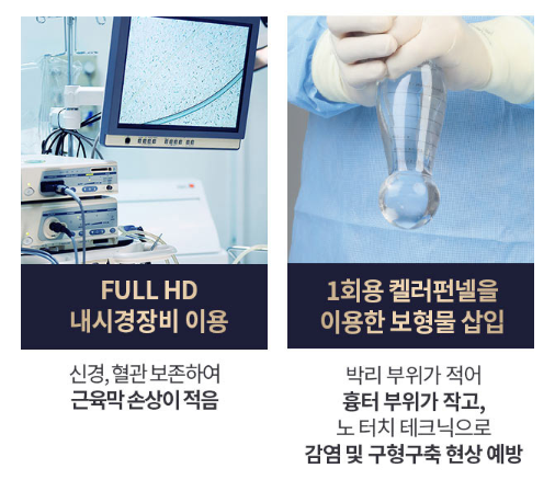 모티바가슴성형수술 알아봐야 할 정보 (촉감, 움직임과 모양) 관련 이미지 5