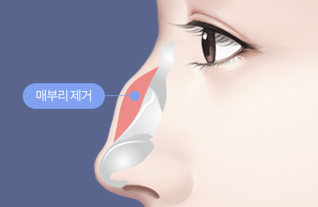 Things to Consider When Thinking About Revision Surgery for a Hump Nose image 5