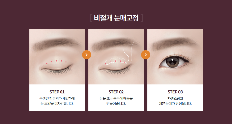 눈매교정 나에게 꼭 필요한 수술일까? 눈 상태에 따른 판단 기준 관련 이미지 3