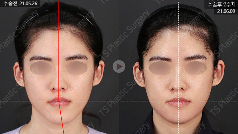 주걱턱, 양악수술 없이 턱끝수술로 개선할 수 있을까요? 관련 이미지 3