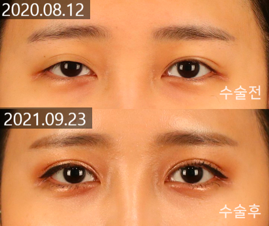 Changes and Causes That Can Occur When the Double Eyelid Line Becomes Weaker image 3