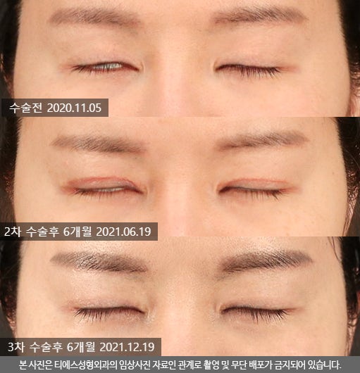 티에스 극한눈 재수술 리뷰(1) 피부부족, 비대칭, 토안증이 심했던 분의 수술전후 변화 관련 이미지 12