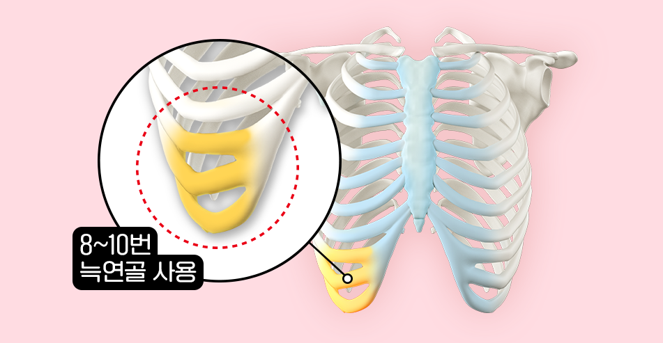 자가늑코성형, 미세절개가 중요한 이유는 무엇일까요? 관련 이미지 1