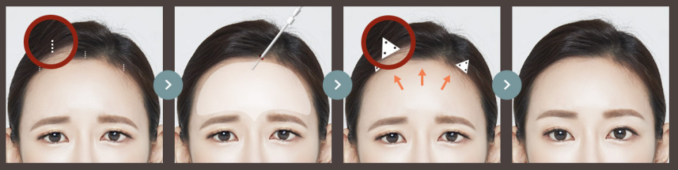 20~30대 이마리프팅 왜 필요할까? 관련 이미지 8