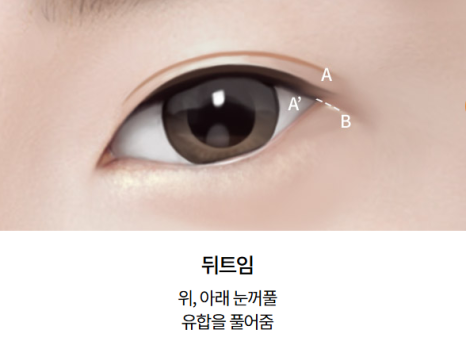 Dual Canthoplasty: Performing Outer and Lower Canthoplasty at the Same Time image 1
