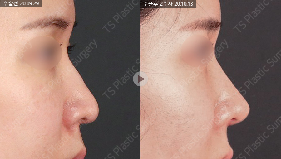Natural Rhinoplasty That Refines the Nasal Tip with Ear Cartilage image 6