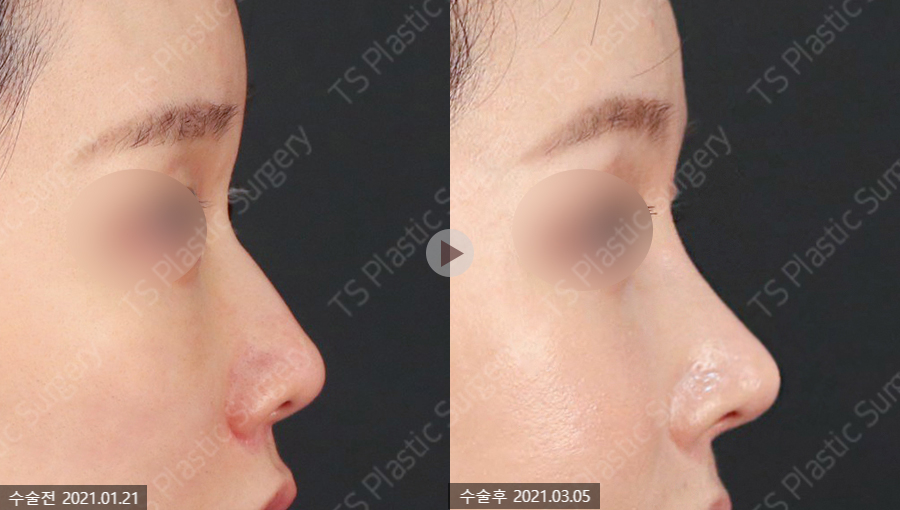 Rhinoplasty: Why Are Angle and Material Selection So Important? image 1
