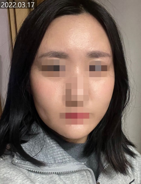 PureCell Fat Grafting: Fat Refinement and Grafting Techniques image 2