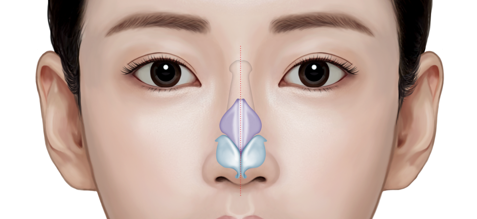 Rhinoplasty Without Implants: Is It Possible for Every Nose? Criteria to Check Before Surgery image 1