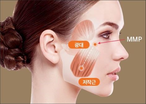 광대축소수술에 효과적인 케이스와 수술 시 고정이 중요한 이유 관련 이미지 5