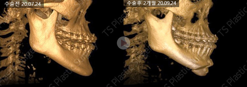 주걱턱, 양악수술 없이 턱끝수술로 개선할 수 있을까요? 관련 이미지 6