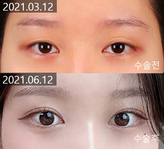 Changes and Causes That Can Occur When the Double Eyelid Line Becomes Weaker image 1