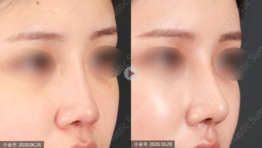 The Key Is Naturalness! Rhinoplasty Completed with Autologous Tissue image 4