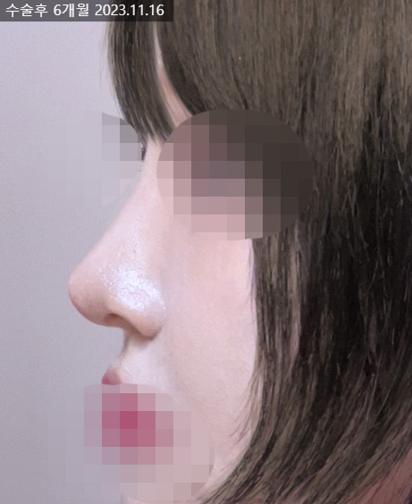 If hump nose surgery and alar reduction are performed together, it may help achieve harmonious facial proportions image 8