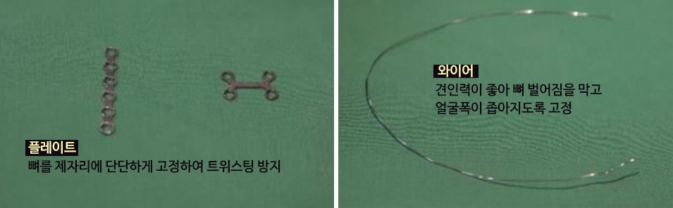 광대축소수술에 효과적인 케이스와 수술 시 고정이 중요한 이유 관련 이미지 7