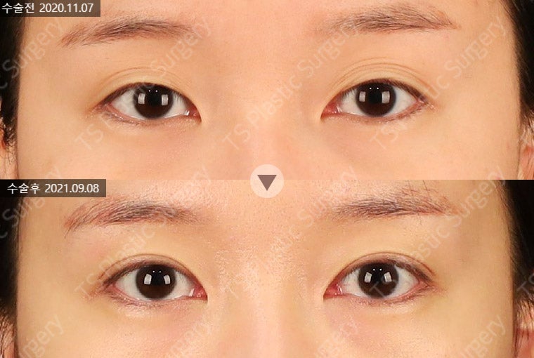 꺼진 눈과 겹주름, 눈두덩이 지방이식 시 주의할 점은? 관련 이미지 4