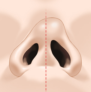 If you are concerned about a crooked nose, consider the degree of deviation, the location, and whether a deviated septum is present image 7