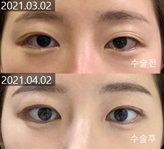 Changes and Causes That Can Occur When the Double Eyelid Line Becomes Weaker image 4