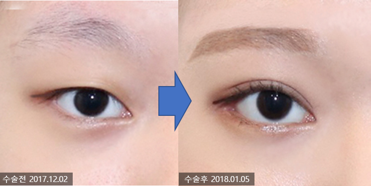 듀얼트임(뒤밑트임)이 효과적인 케이스는? 관련 이미지 6