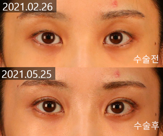 Changes and Causes That Can Occur When the Double Eyelid Line Becomes Weaker image 6
