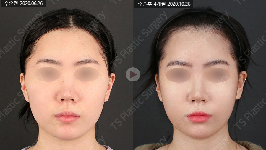 Does Facial Contouring Surgery Always Require All 3 Procedures? Cases Where Zygoma Reduction Surgery Alone Can Create a Smaller, Smoother Face image 11