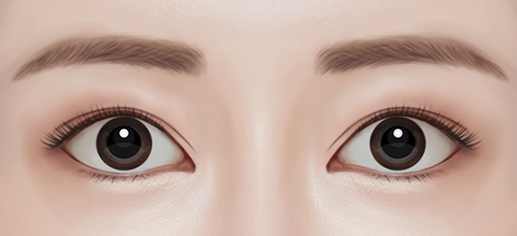 Revision Eye Surgery: Is Correction of Upper Eyelid Retraction in Excessively Open Eyes Really Necessary? image 1