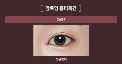 Can the Line Be Changed Because of an Epicanthoplasty Scar? How to Change It to an Outlined, Inline, or In-Out Line image 4