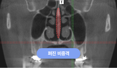 If you are concerned about a crooked nose, consider the degree of deviation, the location, and whether a deviated septum is present image 4