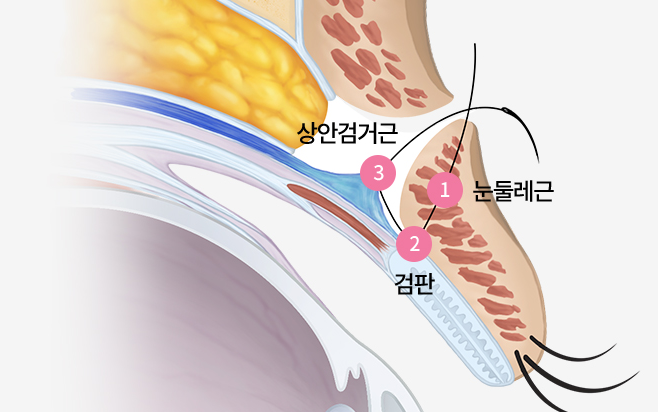 자연스러운 절개쌍꺼풀 수술: 자연미를 고려한 수술 방법 관련 이미지 1