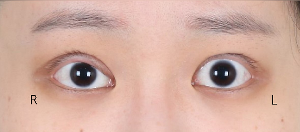 Revision Eyelid Surgery Review (3) Extreme Eyes, Cases of Improvement After Overcorrection in Eyelid Correction image 2