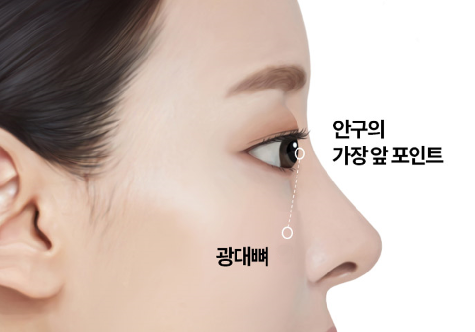 How Can You Avoid Needing Revision Surgery After Double Eyelid Surgery? image 4
