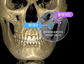 윤곽수술(광대축소수술, 사각턱수술) 후 볼처짐, 살처짐은 걱정해야 하는 부분일까? 관련 이미지 5