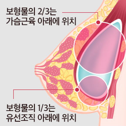 가슴 수술의 중요 포인트: 안전하고 신뢰할 수 있는 선택 관련 이미지 6