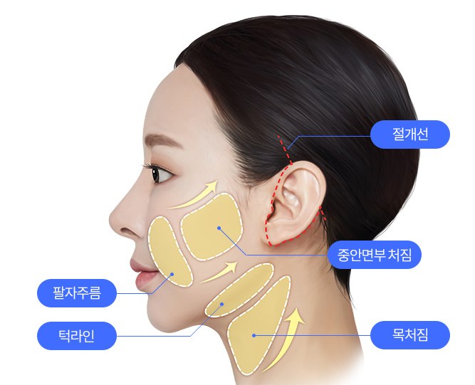안면거상술이 필요한 경우는? 얼굴거상술이 도움이 될 수 있는 경우를 알아보세요! 관련 이미지 2