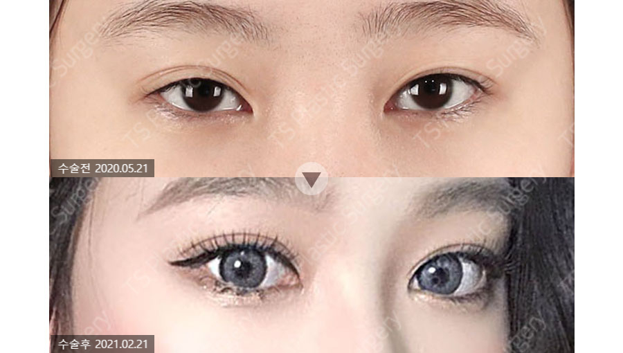 How Can You Avoid Needing Revision Surgery After Double Eyelid Surgery? image 3