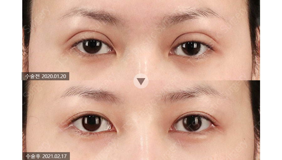 How Can You Avoid Needing Revision Surgery After Double Eyelid Surgery? image 1