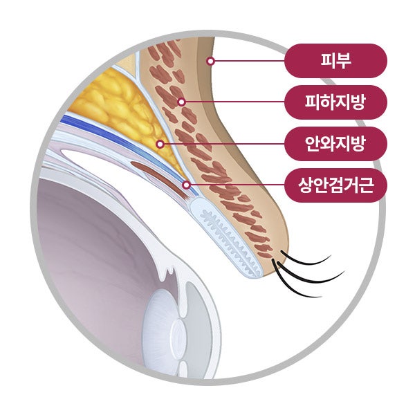 꺼진 눈과 겹주름, 눈두덩이 지방이식 시 주의할 점은? 관련 이미지 3