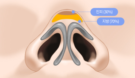 자가늑연골로 복코코끝성형 하는 방법은 관련 이미지 1