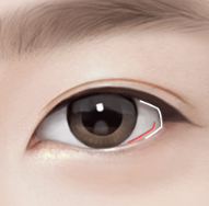 Canthoplasty and Lateral Canthoplasty to Soften the Eyes image 4