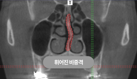 If you are concerned about a crooked nose, consider the degree of deviation, the location, and whether a deviated septum is present image 3