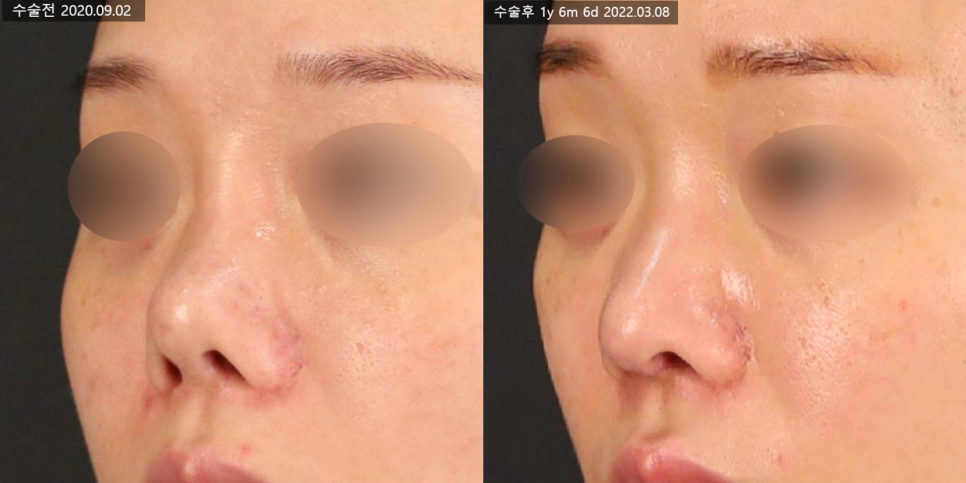 What Is Contracted Nose? Causes That Can Lead to Revision Rhinoplasty and Key Management Points image 2