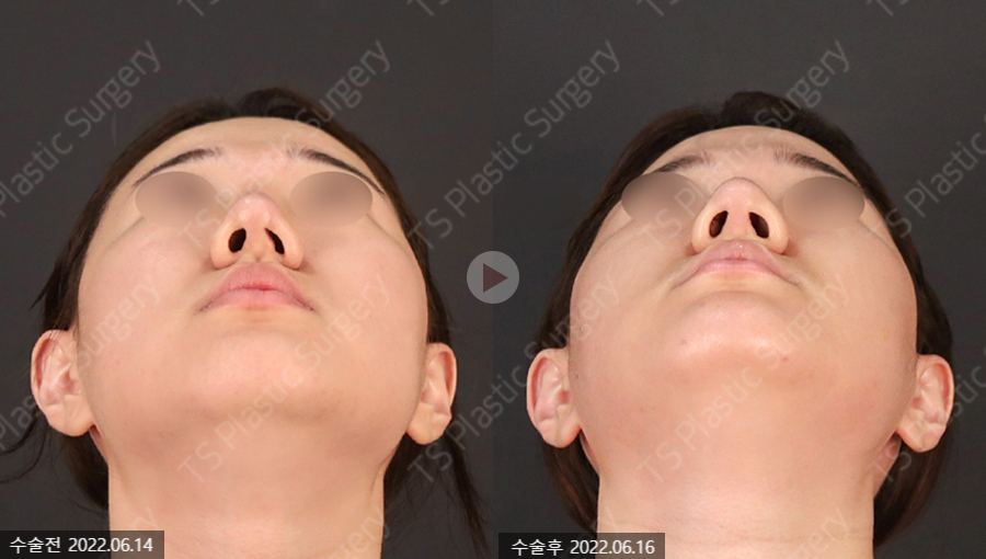 How Can a Deviated Septum After Rhinoplasty Be Corrected Without an Incision? image 3