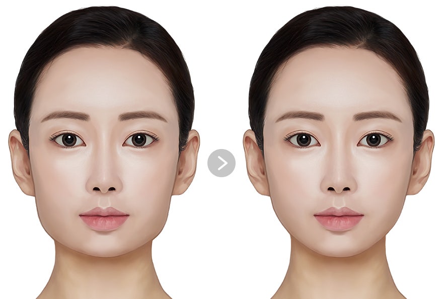 턱끝수술, 짧은 턱과 세로 길이 고민에 도움 될 수 있을까? 관련 이미지 2