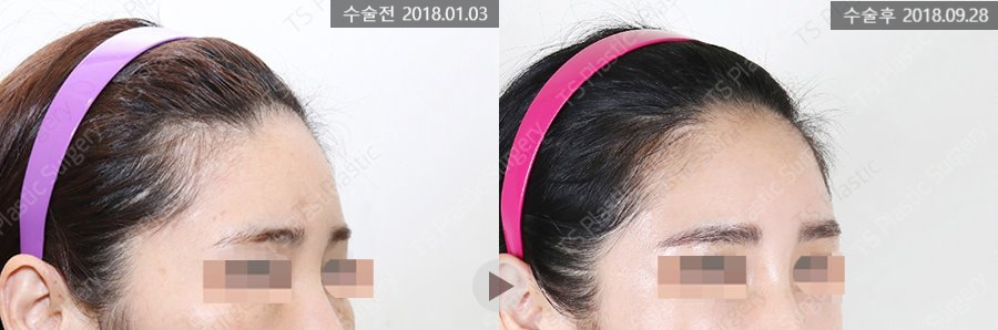 안면윤곽수술 후 헤어라인 교정과 모발이식이 필요한 이유는? 관련 이미지 6
