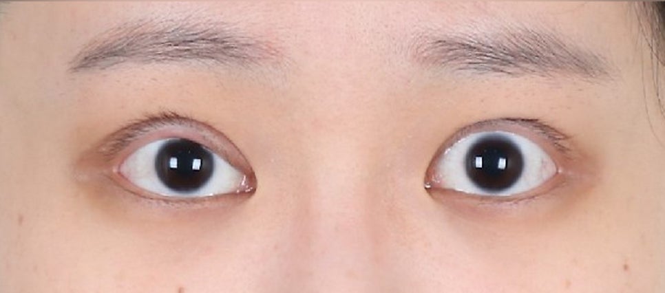 Revision Eyelid Surgery Review (3) Extreme Eyes, Cases of Improvement After Overcorrection in Eyelid Correction image 1