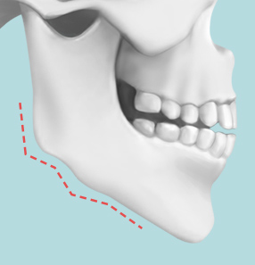 Things to Know About Contouring Surgery and Precautions image 1