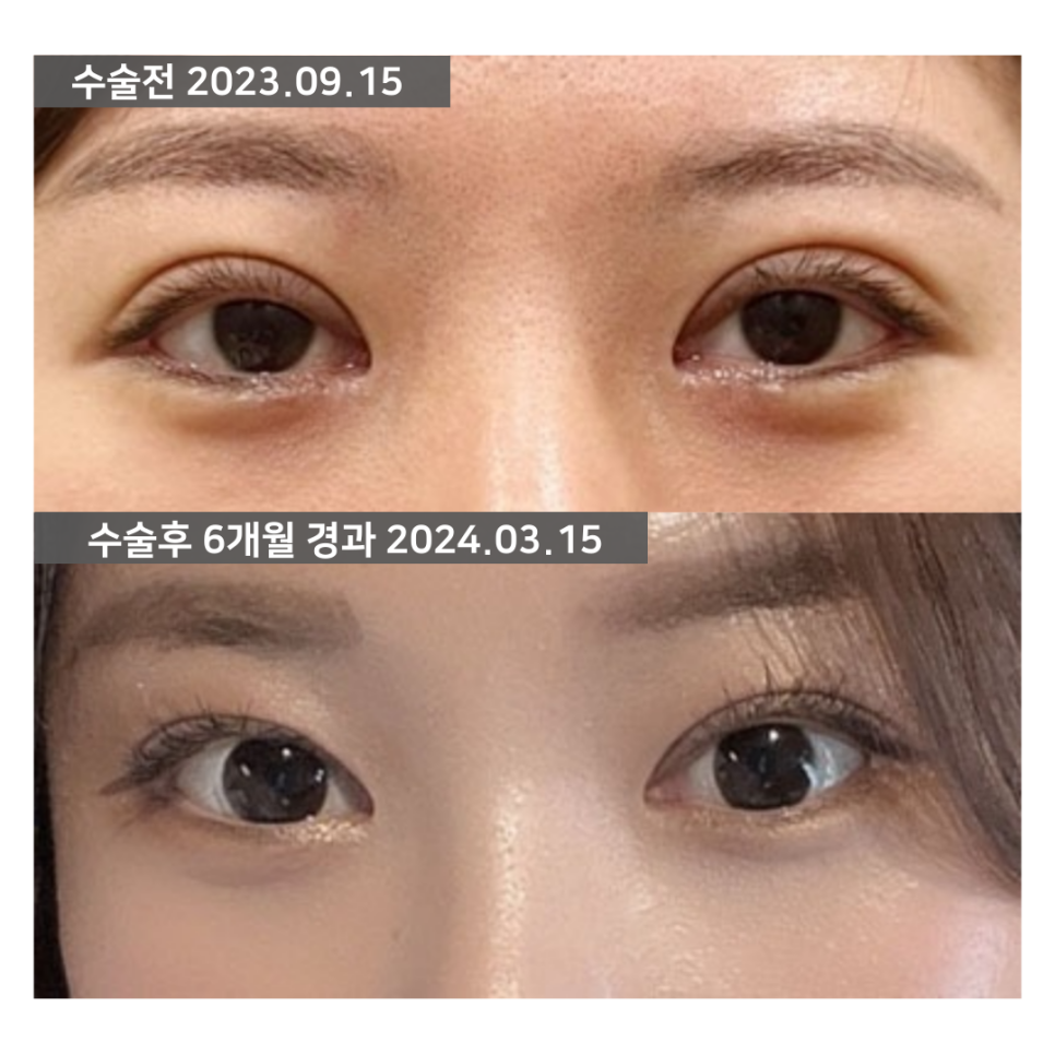 두꺼운 쌍꺼풀 라인을 낮출 때, 두줄따기 방법을 고려할 수 있는 이유 관련 이미지 3