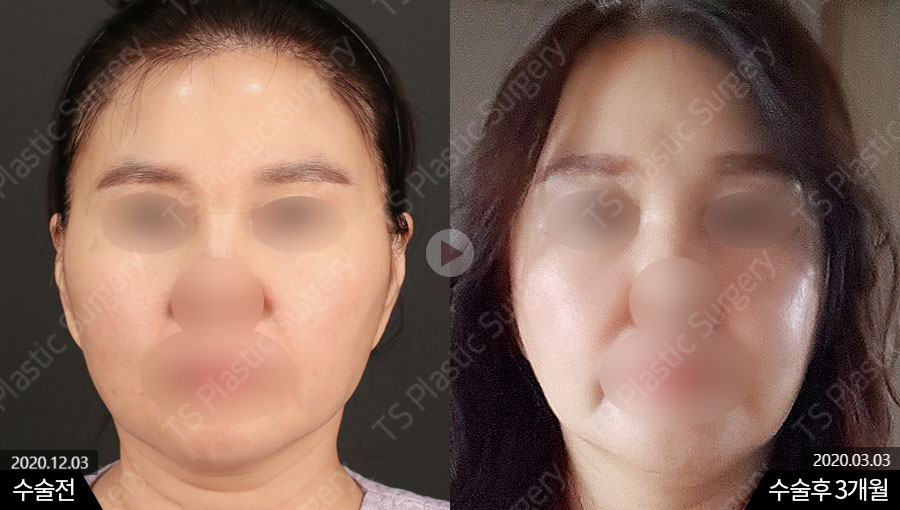 윤곽수술(광대축소수술, 사각턱수술) 후 볼처짐, 살처짐은 걱정해야 하는 부분일까? 관련 이미지 1