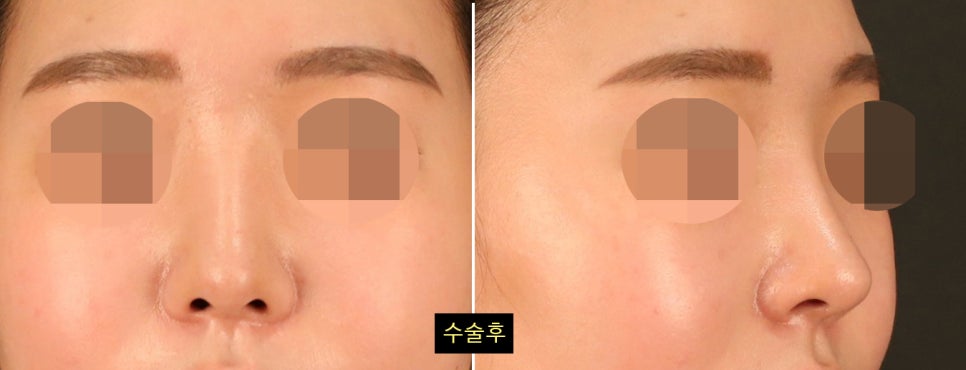 코수술 후 변화가 뚜렷하게 느껴지는 얼굴 유형 4가지 관련 이미지 8
